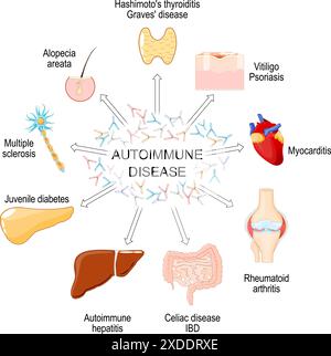 Autoimmunerkrankung. Gewebe des Körpers von Autoimmunangriffen betroffen. Das menschliche Immunsystem. Vektorposter Stock Vektor