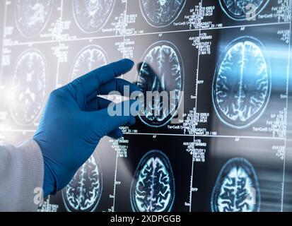 Neurologie Forschung, Arzt beobachtet einen Patienten MRT Scan auf Schäden Stockfoto