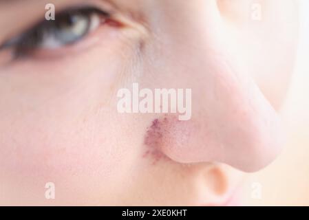 Roter zyanotischer Ausschlag bei Nahaufnahme der Nase der Frau. Symptome einer hämorrhagischen Vaskulitis Konzept Stockfoto