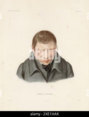 Mann mit Lepra. Buch 'Voyage en Islande et au Groënland' von Louis-Eugène Robert. Illustriert von Antoine Maurin und veröffentlicht 1835–1836. Kredit:Photo12 Stockfoto