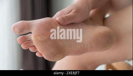 Schmutzige und vernachlässigte Füße, Pflege und Pediküre erforderlich Stockfoto