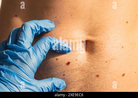 Dermatologe überprüft männliche Muttermale. Arzt in medizinischen Handschuhen, der Männerhaut untersucht. Das Verfahren zur Krebsvorsorge. Stockfoto