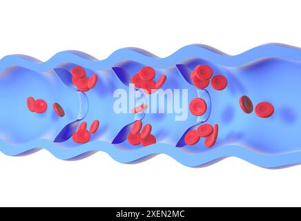 Anatomische 3D-Animation einer erkrankten und inkompetenten Vene. Fehlfunktion der Klappen, Anreicherung roter Blutkörperchen in den Wänden, verursacht Krampfadern. Stockfoto