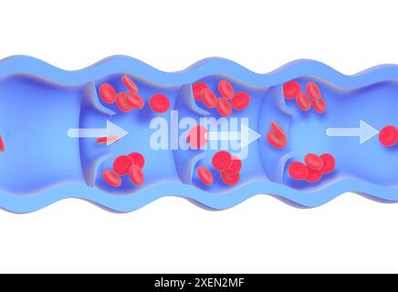 Anatomische 3D-Animation einer erkrankten und inkompetenten Vene. Fehlfunktion der Klappen, Anreicherung roter Blutkörperchen in den Wänden, verursacht Krampfadern. Stockfoto