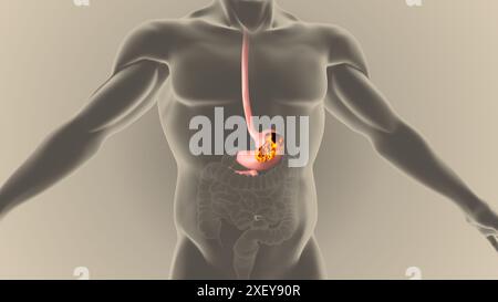 Gerd-Acidität Magenreflux Sodbrennen Schmerzen Stockfoto