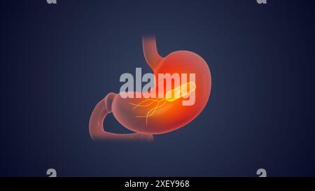 Helicobacter pylori im menschlichen Magen Stockfoto