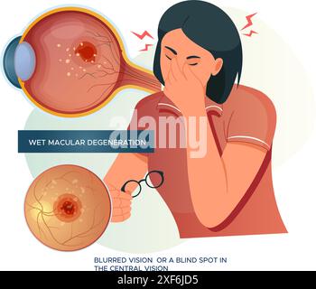 Feuchte Makuladegeneration – verschwommenes Sehen – Stock-Illustration als EPS 10-Datei Stock Vektor