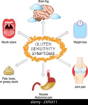 Glutenempfindlichkeitssymptome. Gluten-Intoleranz. Zöliakie. Infografiken. Vektorabbildung Stock Vektor