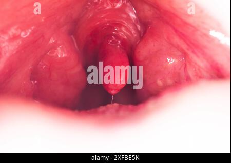 Rote, entzündete und geschwollene Uvula im Hals. Behandlung der Uvulitis durch Bakterien und Streptokokkenviren. Hno-Heilkunde Stockfoto