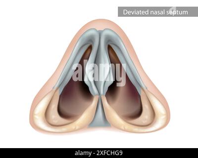 Abweichendes Nasenseptum. Nase, Nasenhöhle. Untere Ansicht Stock Vektor