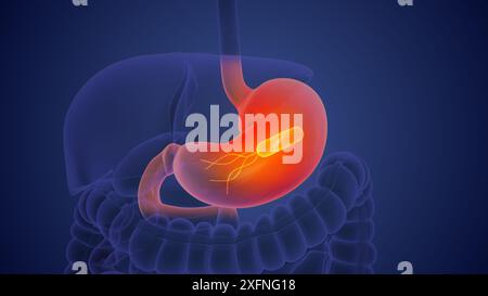 Helicobacter pylori im menschlichen Magen Stockfoto