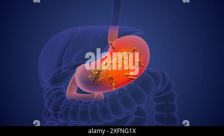 Helicobacter pylori verursacht chronische Entzündungen und Magenkrebs Stockfoto