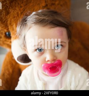 Kleinkind mit großen blauen Fleck auf der Stirn nach stoßen. Kinder oft versehentlich den Kopf stoßen. Stockfoto