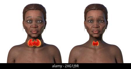 Abbildung einer älteren Frau mit Morbus Basedow (links), die eine vergrößerte Schilddrüse (Struma, rot hervorgehoben) und abnorme Vorwölbung der Augen (Exophthalmus) verursacht, im Vergleich zu derselben gesunden Frau (rechts). Morbus Basedow ist eine Autoimmunerkrankung, bei der Antikörper produziert werden, die die Schilddrüse veranlassen, übermäßige Hormone zu produzieren. Stockfoto