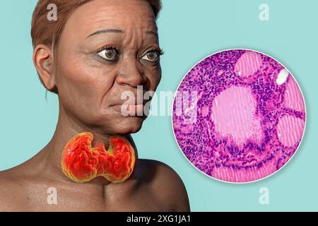 Illustration einer Frau mit Morbus Basedow und Nahaufnahme des betroffenen Schilddrüsengewebes. Morbus Basedow kann zur Entwicklung einer vergrößerten Schilddrüse (Struma, Nackenbasis) führen und eine abnorme Vorwölbung der Augen (Exophthalmus) verursachen. Morbus Basedow ist eine Autoimmunerkrankung, bei der Antikörper produziert werden, die die Schilddrüse veranlassen, übermäßige Hormone zu produzieren. Stockfoto