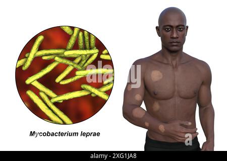 Illustration eines Mannes mit hypopigmentierten Läsionen an Arm und Rumpf durch tuberkuloide Lepra und Nahaufnahme des ursächlichen Mycobacterium leprae-Bakteriums. Stockfoto