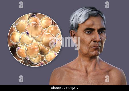 Illustration eines Mannes mit Lipom auf der Stirn und Nahaufnahme der Adipozyten (Fettzellen), aus denen das Lipom besteht. Lipome sind gutartig (nicht krebsartig) und erfordern in der Regel keine Behandlung. Stockfoto