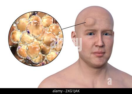 Illustration eines Mannes mit Lipom auf der Stirn und Nahaufnahme der Adipozyten (Fettzellen), aus denen das Lipom besteht. Lipome sind gutartig (nicht krebsartig) und erfordern in der Regel keine Behandlung. Stockfoto