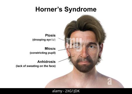 Abgebildete Illustration eines Mannes mit Horner-Syndrom. Dies ist eine seltene Erkrankung, die auf einer Seite des Gesichts aufgrund einer Störung des sympathischen Nervs Ptosis (Tropfen des Augenlids), Miosis (Pupillenverengung) und Anhidrose (Schwitzen) verursacht. Stockfoto