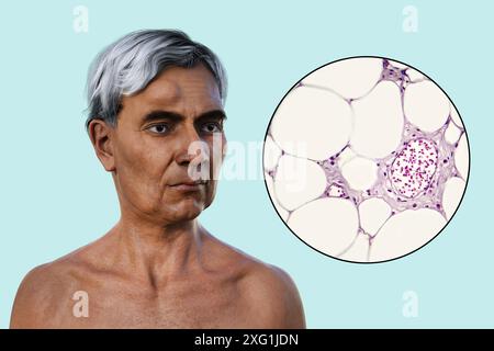 Illustration eines Mannes mit Lipom auf der Stirn und Nahaufnahme der Adipozyten (Fettzellen), aus denen das Lipom besteht. Lipome sind gutartig (nicht krebsartig) und erfordern in der Regel keine Behandlung. Stockfoto