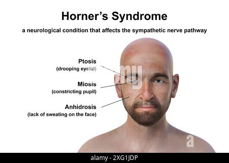 Abgebildete Illustration eines Mannes mit Horner-Syndrom. Dies ist eine seltene Erkrankung, die auf einer Seite des Gesichts aufgrund einer Störung des sympathischen Nervs Ptosis (Tropfen des Augenlids), Miosis (Pupillenverengung) und Anhidrose (Schwitzen) verursacht. Stockfoto