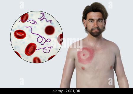 Abbildung zeigt Erythema migrans, ein charakteristischer Hautausschlag bei Patienten mit Lyme-Borreliose gesehen, und eine Nahaufnahme der ursächlichen Borrelia burgdorferi Bakterien. Dieses Bakterium wird typischerweise über einen Insektenvektor, wie z. B. eine Zecke, auf den Menschen übertragen. Stockfoto