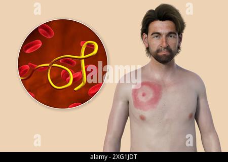 Abbildung zeigt Erythema migrans, ein charakteristischer Hautausschlag bei Patienten mit Lyme-Borreliose gesehen, und eine Nahaufnahme der ursächlichen Borrelia burgdorferi Bakterien. Dieses Bakterium wird typischerweise über einen Insektenvektor, wie z. B. eine Zecke, auf den Menschen übertragen. Stockfoto