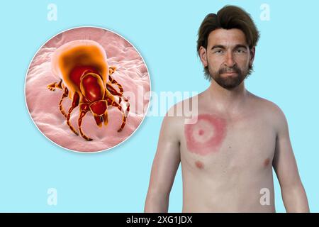 Abbildung zeigt Erythema migrans, ein charakteristischer Hautausschlag bei Patienten mit Lyme-Borreliose gesehen, und eine Nahaufnahme einer Zecke. Lyme-Borreliose wird durch Borrelia burgdorferi Bakterien verursacht. Es wird typischerweise über einen Insektenvektor auf den Menschen übertragen, wobei Zecken die häufigste sind. Stockfoto