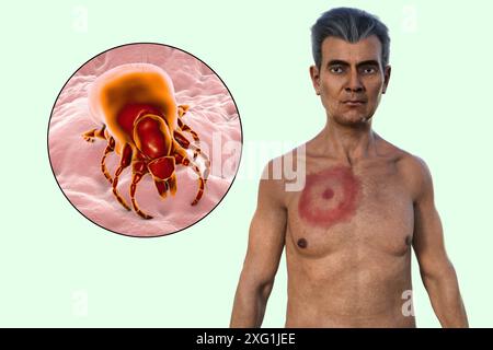 Abbildung zeigt Erythema migrans, ein charakteristischer Hautausschlag bei Patienten mit Lyme-Borreliose gesehen, und eine Nahaufnahme einer Zecke. Lyme-Borreliose wird durch Borrelia burgdorferi Bakterien verursacht. Es wird typischerweise über einen Insektenvektor auf den Menschen übertragen, wobei Zecken die häufigste sind. Stockfoto