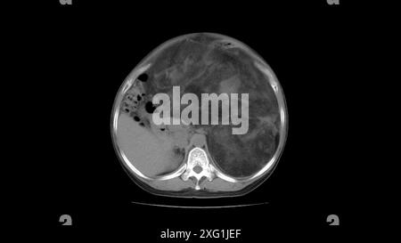 Computertomographie (CT) des Abdomens eines Patienten mit einem großen Liposarkom (dunkel, Mitte rechts). Liposarkome sind maligne (krebsartige) Tumoren, die sich aus Fettgewebe entwickeln. Es handelt sich um langsam wachsende Tumoren, die sich wahrscheinlich nicht ausbreiten (Metastasierung). Die Behandlung erfolgt mit einer chirurgischen Entfernung des Tumors, die jedoch häufig wiederholt auftreten. Stockfoto