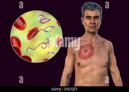 Abbildung zeigt Erythema migrans, ein charakteristischer Hautausschlag bei Patienten mit Lyme-Borreliose gesehen, und eine Nahaufnahme der ursächlichen Borrelia burgdorferi Bakterien. Dieses Bakterium wird typischerweise über einen Insektenvektor, wie z. B. eine Zecke, auf den Menschen übertragen. Stockfoto