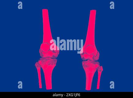 Farbige Computertomographie (CT) gesunder Knie. Stockfoto