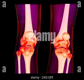Farbige Computertomographie (CT) gesunder Knie. Stockfoto