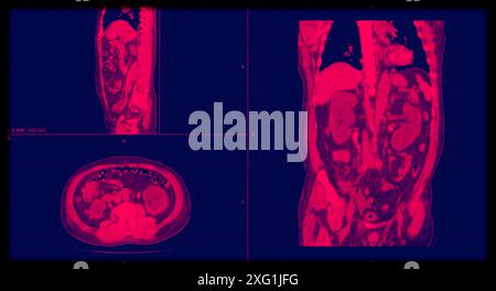 Computertomographie (CT) eines Patienten mit Ureterolithiasis (Nierensteine, kleine hellere Bereiche im Abdomen), seitlich, vorne und oben. Stockfoto