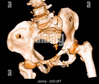 Farbige Computertomographie (CT) eines Beckenbruchs, von vorne und rechts gesehen. Die Fraktur ist rechts unten neben dem linken Femur (Oberschenkelknochen) des Patienten sichtbar. Diese Verletzung wurde durch einen Verkehrsunfall verursacht. Stockfoto