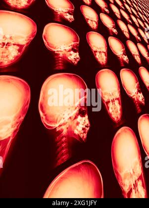 Farbige Röntgenbilder eines gesunden Schädels aus anteriorer (Front-) und lateraler (seitlicher) Sicht. Stockfoto