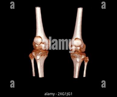 Farbige Computertomographie (CT) gesunder Knie. Stockfoto