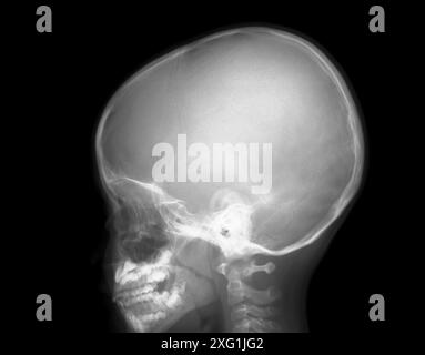 Röntgenbild eines Schädels mit vergrößerten Adenoiden (rechts der oberen Zähne). Adenoide sind Drüsen hinter dem Nasengang, die dazu beitragen, Mikroben einzufangen, die durch Nase und Mund in den Körper gelangen. Sie kommen normalerweise nur bei Kindern vor und beginnen nach 5 Jahren zu verschwinden, meist fehlen sie im Erwachsenenalter. Stockfoto