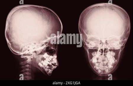 Röntgenaufnahmen eines gesunden Schädels aus anteriorer (Front-) und lateraler (seitlicher) Sicht. Stockfoto