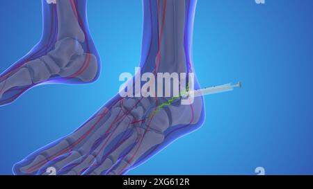 Krampfaderbehandlung medizinische Animation Stockfoto