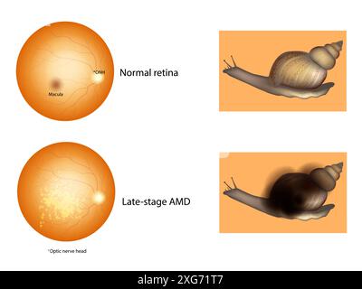 Altersabhängige Makuladegeneration oder AMD. AMD im Spätstadium und normale Netzhaut. Medizinische Illustration Stock Vektor