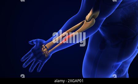 Das medizinische Konzept der Ulna-Knochenbrüche Stockfoto