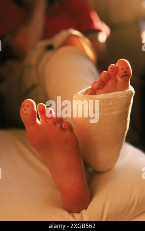 Smilie-Gesichter schmücken die Zehen eines in Gips eingefassten Beines einer Frau. Stockfoto