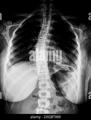 Röntgenaufnahme der idiopathischen Skoliose der Brustwirbelsäule. Ein Teil eines Jugendskeletts mit Wirbelsäulenkrümmung auf schwarzem Hintergrund. Laterale Rückgradeformation. Radiologisches Anatomiebild. Stockfoto