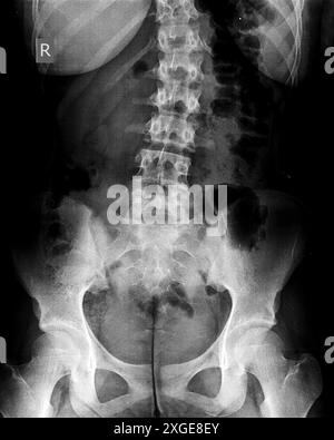 Röntgenaufnahme der idiopathischen Skoliose der Lendenwirbelsäule. Ein Teil eines Jugendskeletts mit Wirbelsäulenkrümmung auf schwarzem Hintergrund. Seitliche Rückenmarksbiegung. Radiologisch-anatomisches Bild des unteren Rückens und Beckens. Stockfoto