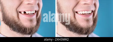 Mann, der Zähne vor und nach Implantatoperationen zeigt, Nahaufnahme. Collage von Fotos auf blauem Hintergrund Stockfoto
