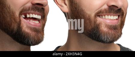 Mann, der Zähne vor und nach Implantatoperationen zeigt, Nahaufnahme. Collage von Fotos auf weißem Hintergrund Stockfoto