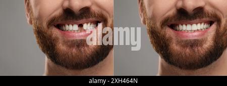 Mann, der Zähne vor und nach Implantatoperationen zeigt, Nahaufnahme. Collage von Fotos auf grauem Hintergrund Stockfoto