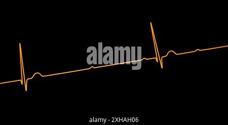 Abbildung eines Elektrokardiogramms (EKG) mit Darstellung eines kompletten Herzblocks (3. Atrioventrikulärer Block). Das EKG zeigt eine vollständige Dissoziation zwischen dem Vorhof- und dem Ventrikelrhythmus. Stockfoto