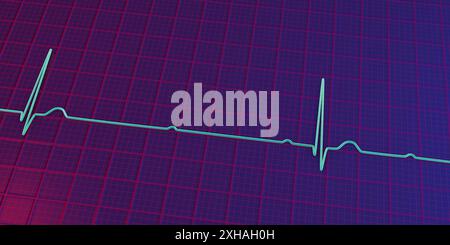 Abbildung eines Elektrokardiogramms (EKG) mit Darstellung eines kompletten Herzblocks (3. Atrioventrikulärer Block). Das EKG zeigt eine vollständige Dissoziation zwischen dem Vorhof- und dem Ventrikelrhythmus. Stockfoto